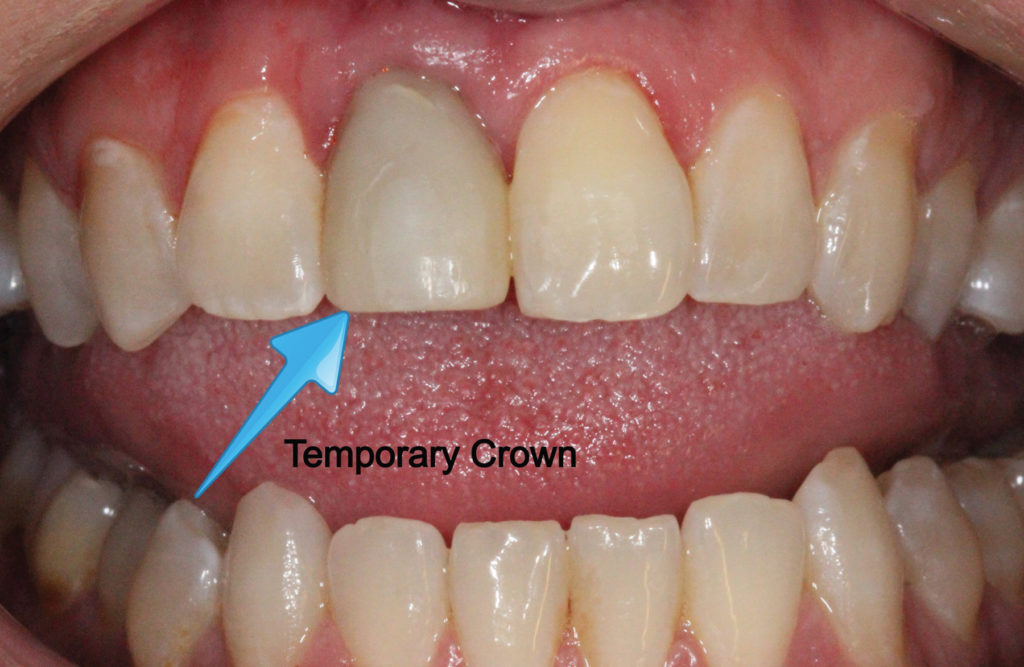 Temporary Teeth Offer Permanent Satisfaction The Cavallini Chronicle